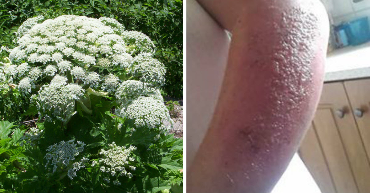 Plant Causes Severe Burns And Even Blindness And Is Now Spreading Quickly Here’s What You